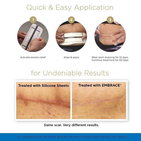 Embrace Scar Treatment - Silicone Sheets for New Scars with Active Scar Defense